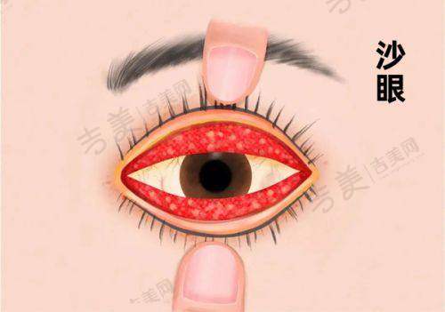 江门新会爱尔新希望眼科医院收费情况