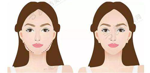 北京嘉禾整形的无创注射项目有哪些优势