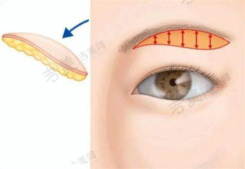 北京嘉禾整形医院的眼部项目特色