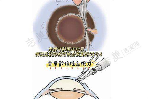 兰州爱尔眼科收费明细更新后的优势与特色