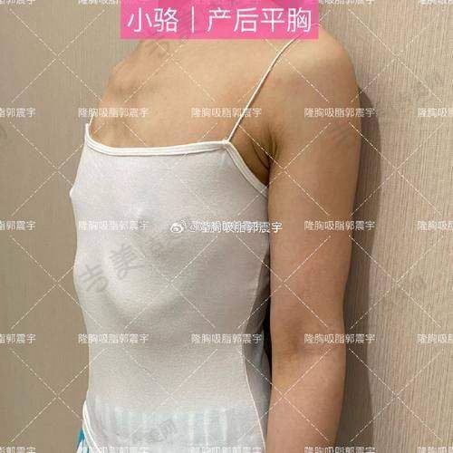 深圳八大处整形医院的隆胸实例成效